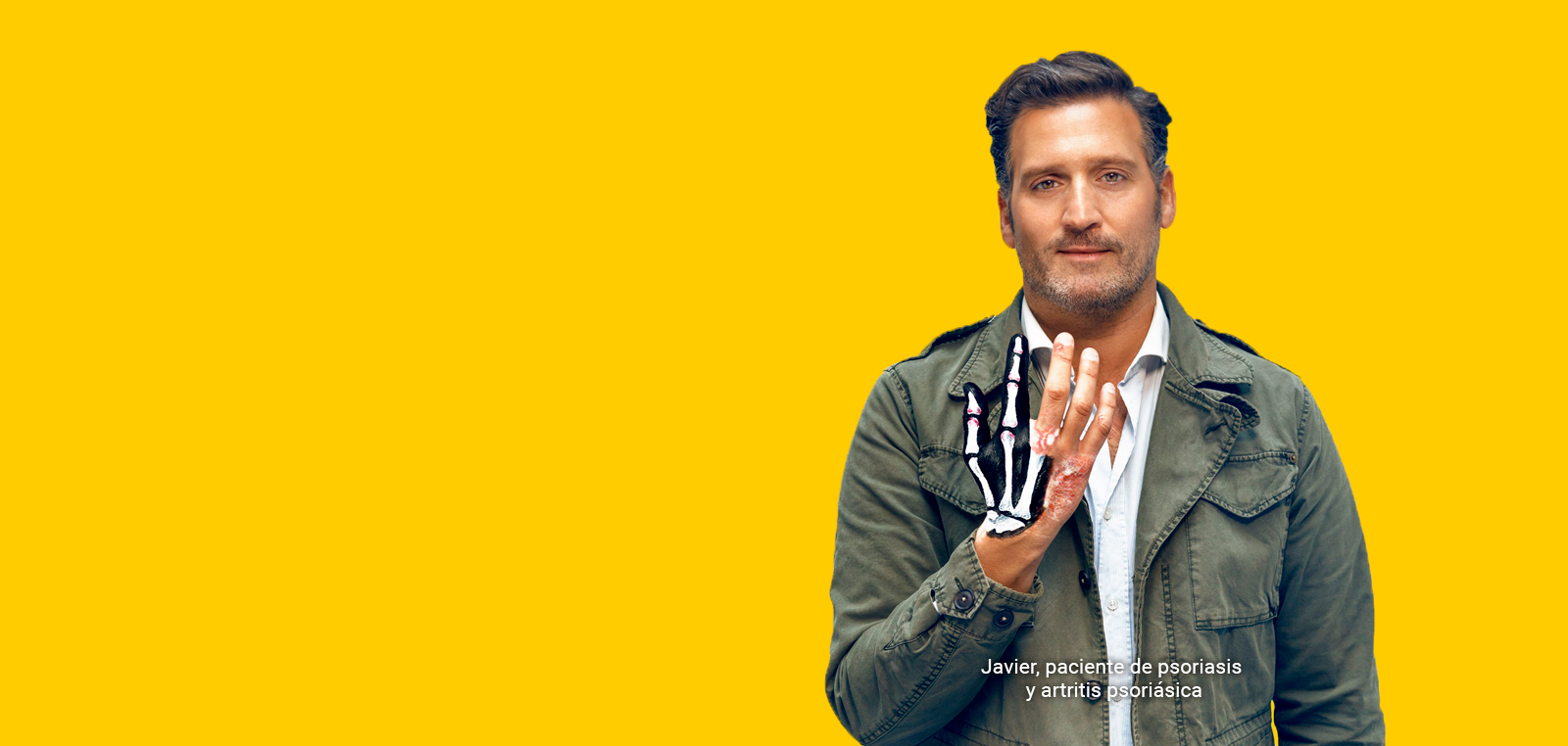 LA PSORIASIS NO SOLO es PIEL. TÚ TAMPOCO LA PSORIASIS NO SOLO es PIEL. TÚ TAMPOCO
