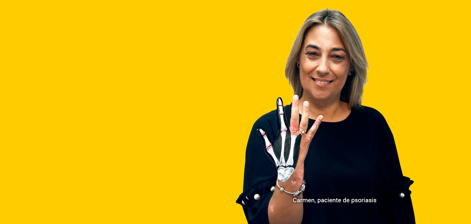 La PSORIASIS no tiene LÍMITES La PSORIASIS no tiene LÍMITES