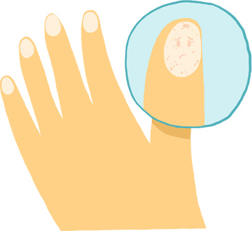 Psoriasis en uñas