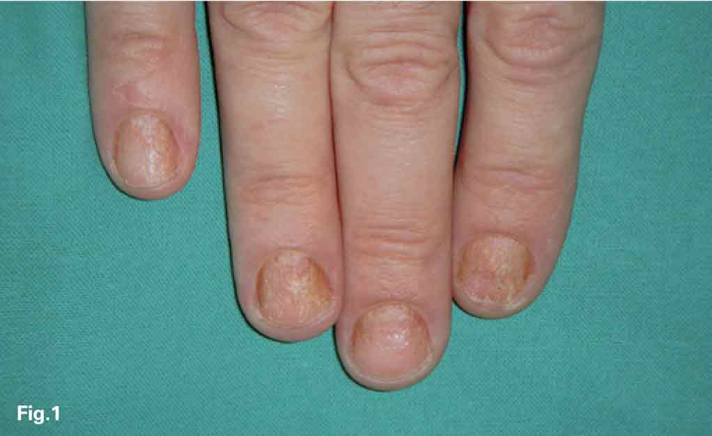 psoriasis ungueal signos